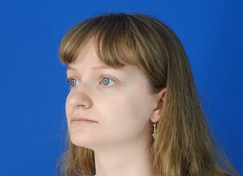 Rhinoplasty Before & After Gallery - Patient 750426 - Image 3