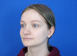 Rhinoplasty Before & After Gallery - Patient 750426 - Image 4