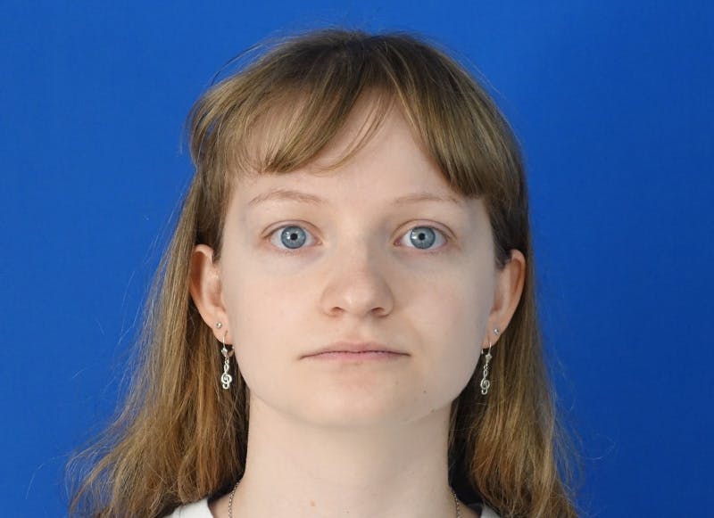 Rhinoplasty Before & After Gallery - Patient 750426 - Image 5