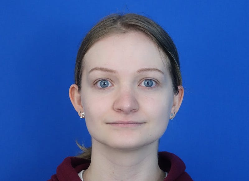 Rhinoplasty Before & After Gallery - Patient 750426 - Image 6