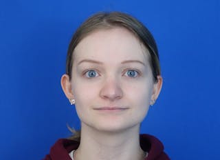 Rhinoplasty Before & After Gallery - Patient 750426 - Image 6