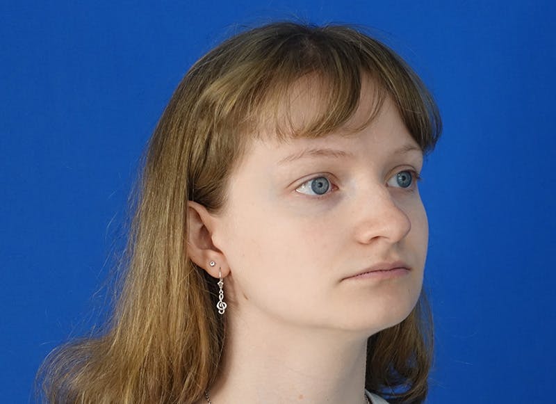 Rhinoplasty Before & After Gallery - Patient 750426 - Image 7