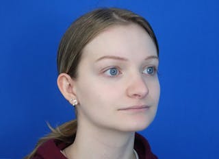 Rhinoplasty Before & After Gallery - Patient 750426 - Image 8