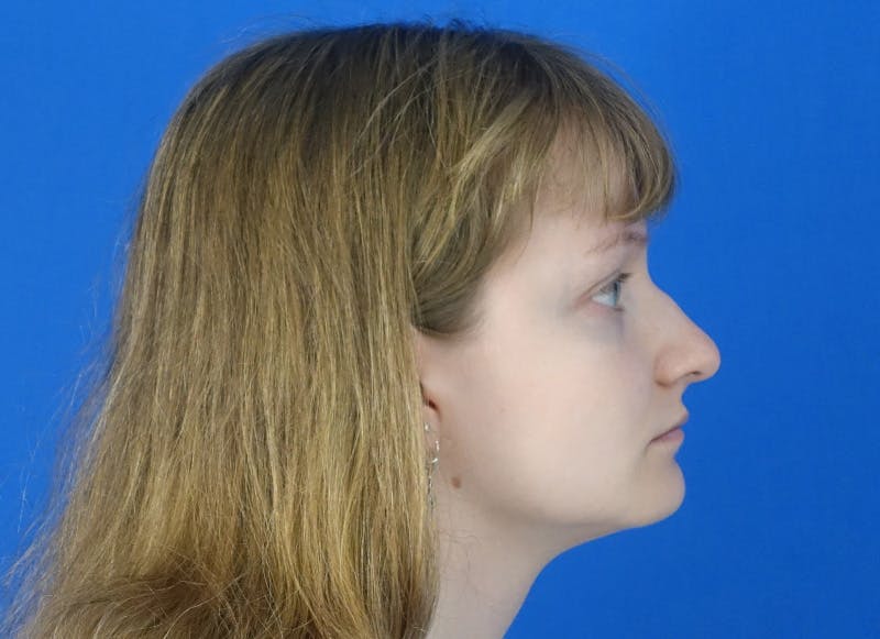 Rhinoplasty Before & After Gallery - Patient 750426 - Image 9