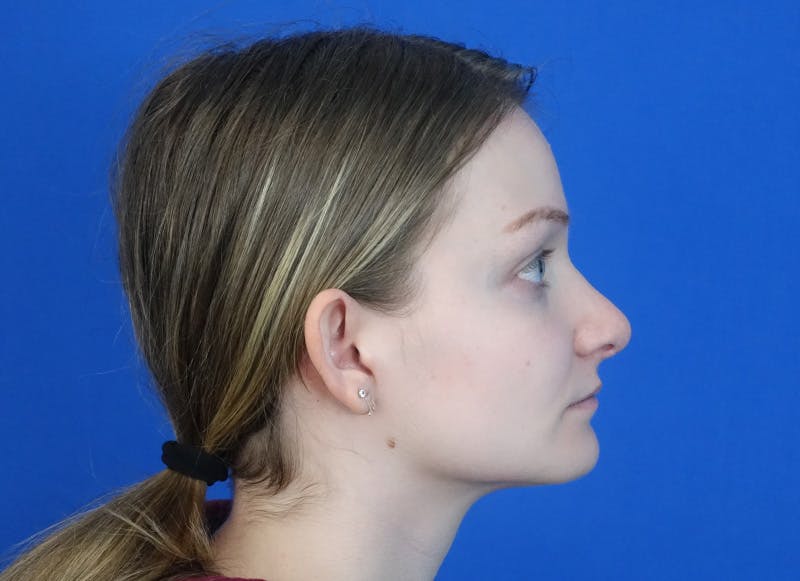 Rhinoplasty Before & After Gallery - Patient 750426 - Image 10