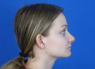 Rhinoplasty Before & After Gallery - Patient 750426 - Image 10