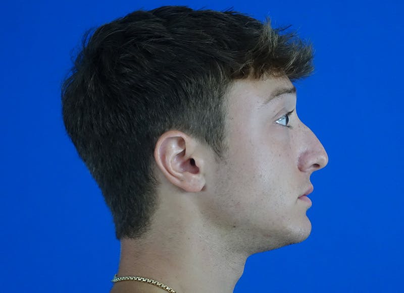 Rhinoplasty Before & After Gallery - Patient 186437 - Image 9