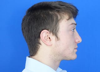 Rhinoplasty Before & After Gallery - Patient 186437 - Image 10