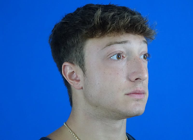 Rhinoplasty Before & After Gallery - Patient 186437 - Image 7