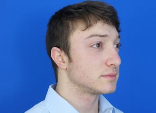 Rhinoplasty Before & After Gallery - Patient 186437 - Image 8