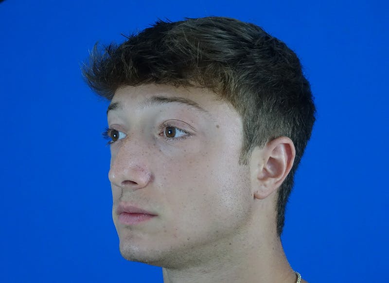 Rhinoplasty Before & After Gallery - Patient 186437 - Image 3