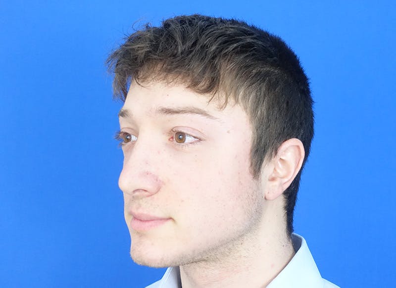Rhinoplasty Before & After Gallery - Patient 186437 - Image 4