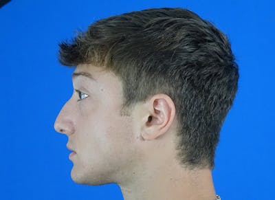 Rhinoplasty Before & After Gallery - Patient 186437 - Image 1
