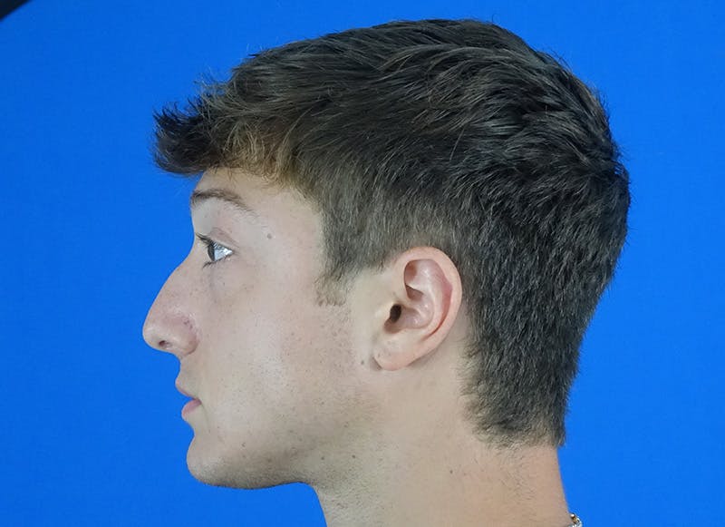 Rhinoplasty Before & After Gallery - Patient 186437 - Image 1