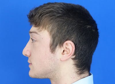 Rhinoplasty Before & After Gallery - Patient 186437 - Image 2