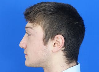 Rhinoplasty Before & After Gallery - Patient 186437 - Image 2