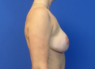 Hybrid Reconstruction Gallery Before & After Gallery - Patient 354570 - Image 10