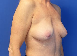 Hybrid Reconstruction Gallery Before & After Gallery - Patient 219289 - Image 8