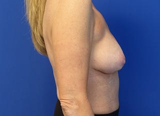 Hybrid Reconstruction Gallery Before & After Gallery - Patient 219289 - Image 10