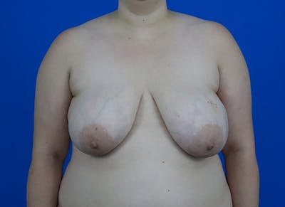 Breast Lift Before & After Gallery - Patient 238869 - Image 5