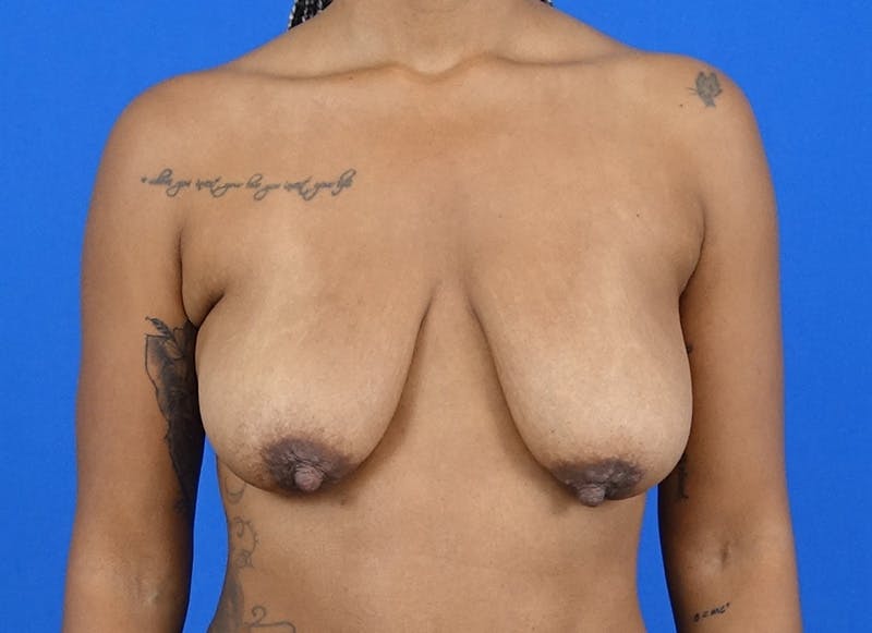 Breast Lift Before & After Gallery - Patient 225600 - Image 5