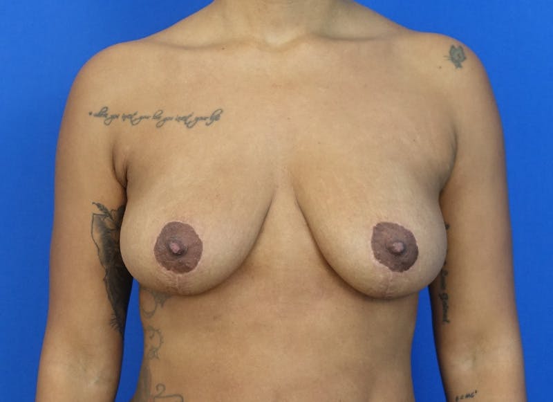 Breast Lift Before & After Gallery - Patient 225600 - Image 6
