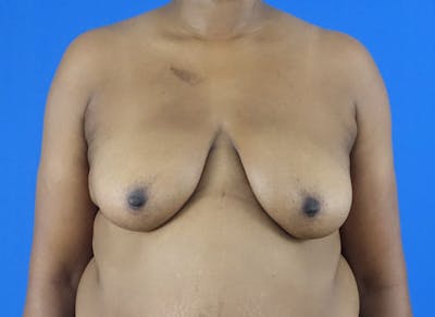 Breast Lift Before & After Gallery - Patient 120254 - Image 5