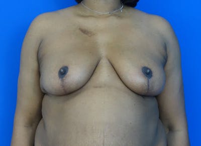 Breast Lift Before & After Gallery - Patient 120254 - Image 6