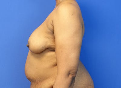 Breast Lift Before & After Gallery - Patient 120254 - Image 1