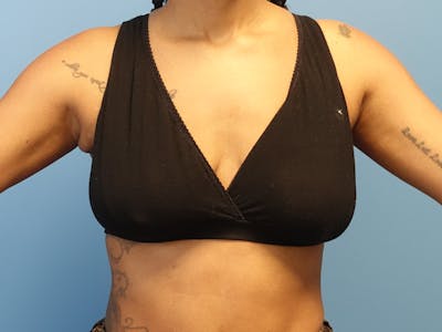 Axillary Breast Removal Before & After Gallery - Patient 404105 - Image 1