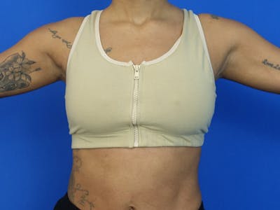 Axillary Breast Removal Before & After Gallery - Patient 404105 - Image 2
