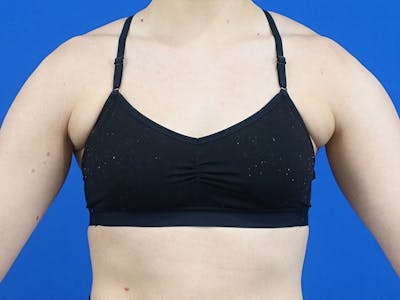 Axillary Breast Removal Before & After Gallery - Patient 457797 - Image 1