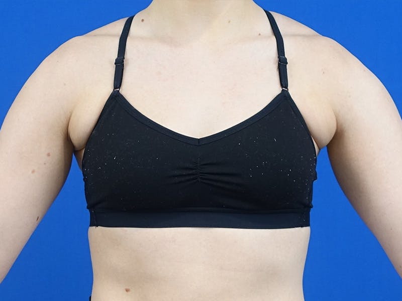 Axillary Breast Removal Before & After Gallery - Patient 457797 - Image 1