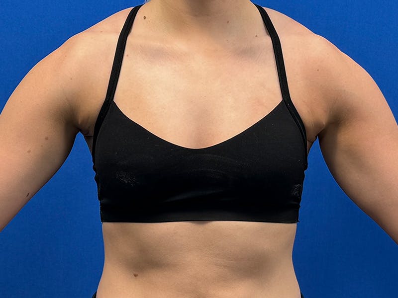 Axillary Breast Removal Before & After Gallery - Patient 457797 - Image 2