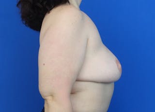 Flap Reconstruction Gallery Before & After Gallery - Patient 340211 - Image 10