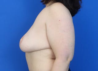 Flap Reconstruction Gallery Before & After Gallery - Patient 340211 - Image 2