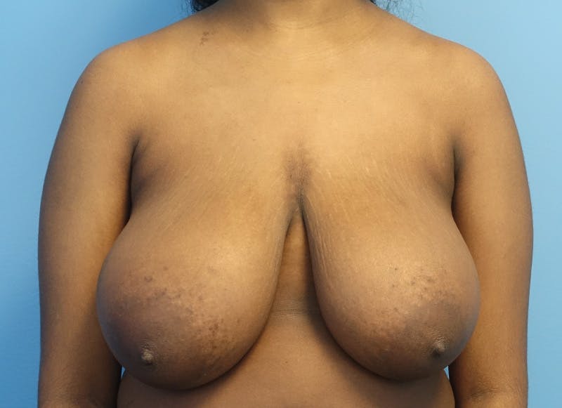 Breast Reduction Before & After Gallery - Patient 303053 - Image 5
