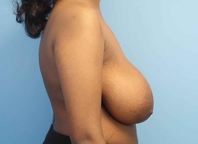Breast Reduction Before & After Gallery - Patient 303053 - Image 9