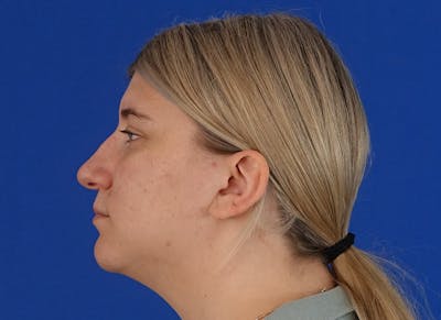 Rhinoplasty Before & After Gallery - Patient 154905 - Image 1