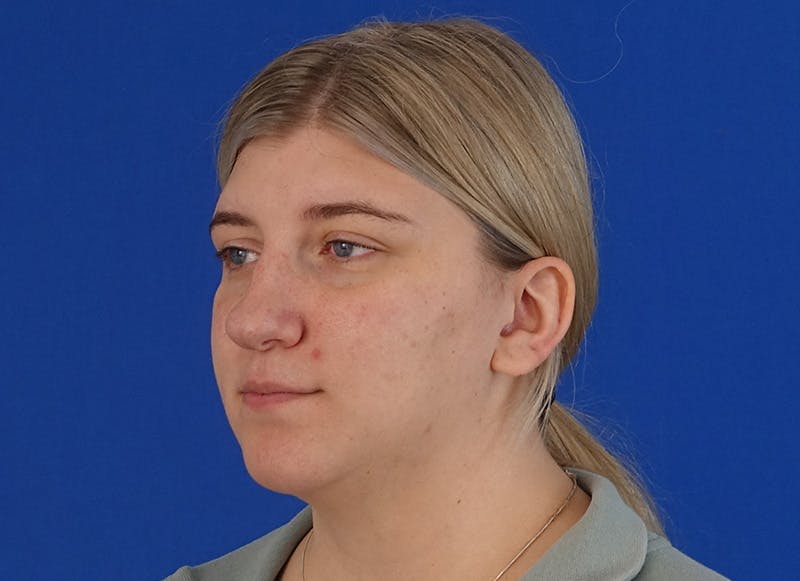 Rhinoplasty Before & After Gallery - Patient 154905 - Image 3