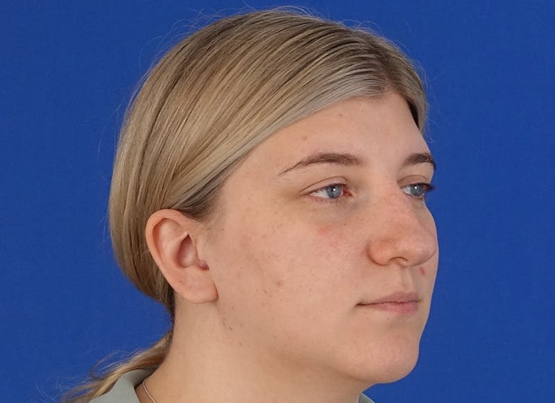 Rhinoplasty Before & After Gallery - Patient 154905 - Image 7