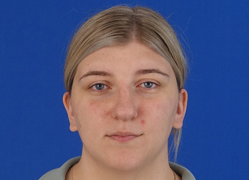 Rhinoplasty Before & After Gallery - Patient 154905 - Image 5