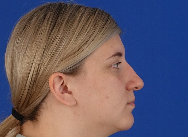 Rhinoplasty Before & After Gallery - Patient 154905 - Image 9