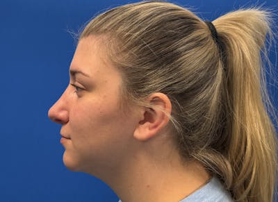 Rhinoplasty Before & After Gallery - Patient 154905 - Image 2