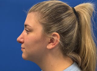 Rhinoplasty Before & After Gallery - Patient 154905 - Image 2