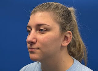Rhinoplasty Before & After Gallery - Patient 154905 - Image 4