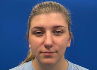 Rhinoplasty Before & After Gallery - Patient 154905 - Image 6