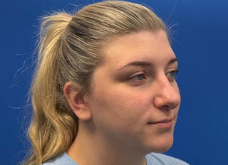 Rhinoplasty Before & After Gallery - Patient 154905 - Image 8