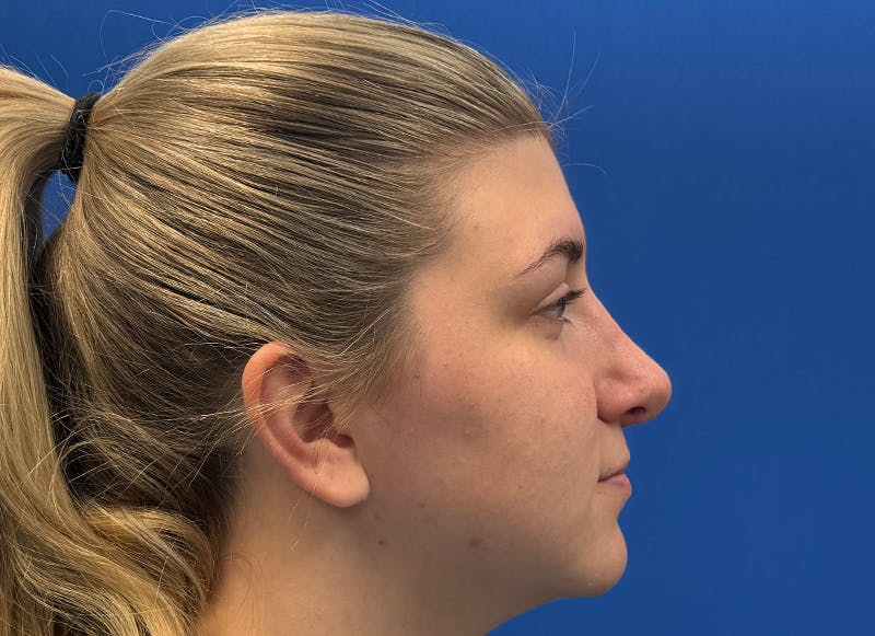 Rhinoplasty Before & After Gallery - Patient 154905 - Image 10