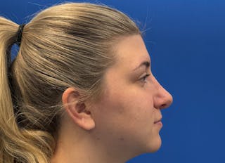 Rhinoplasty Before & After Gallery - Patient 154905 - Image 10